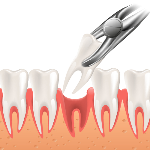 Teeth Extraction and Minor Surgeries